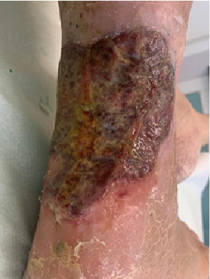 Úlcera Vasculogênica