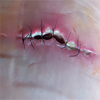 Ostomia