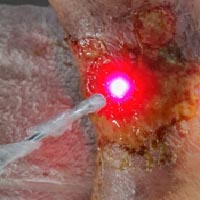 Laserterapia